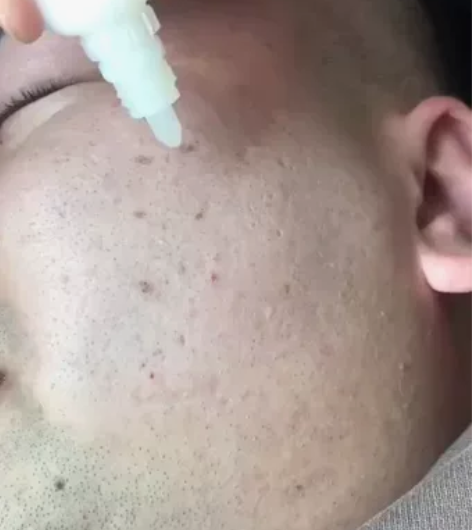 两秒橡皮擦去班2秒去班净化提取液点班水水雾...